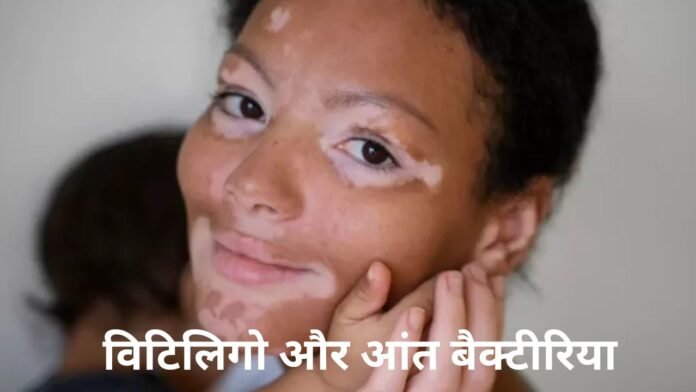 विटिलिगो और आंत बैक्टीरिया